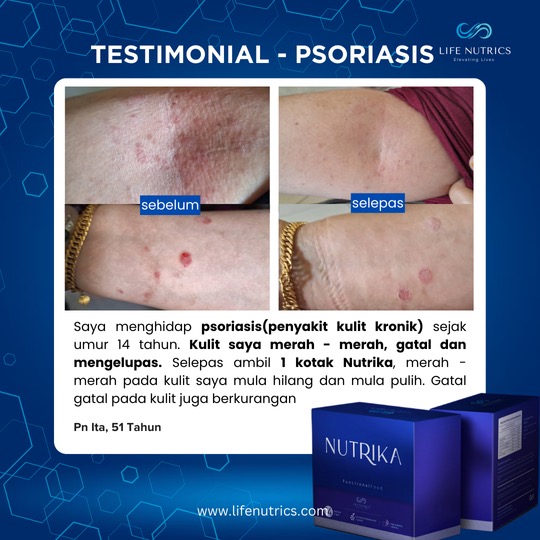 Psoriasis Kronik Sejak 14 Tahun